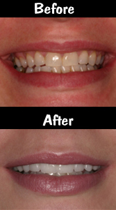 Cosmetic Dentistry Porcelain Veneer Before and After Photos