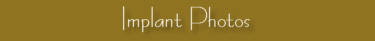 Implant Photos