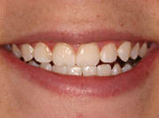 zoom whitening after bleaching