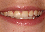 zoom whitening before bleaching
